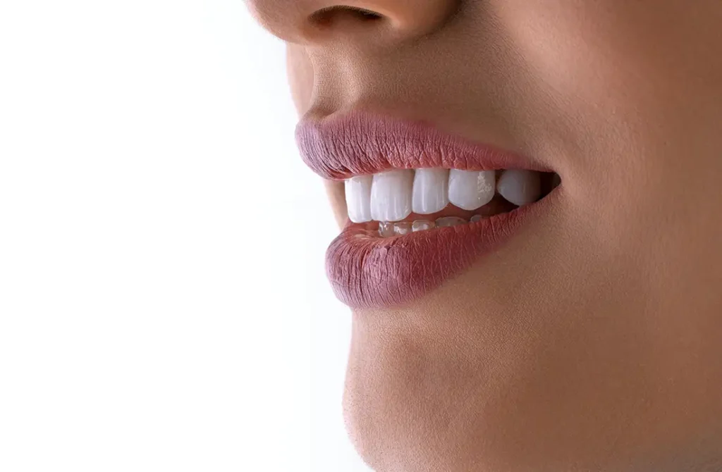 Veneers - bei Ihrem Zahnarzt in Ludwigsburg beim Bahnhof
