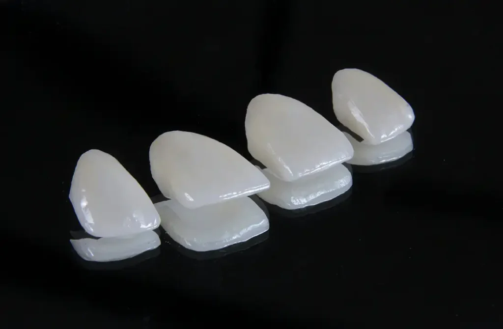 Veneers - Zahnarztpraxis Ludwigsburg Nähe Bahnhof